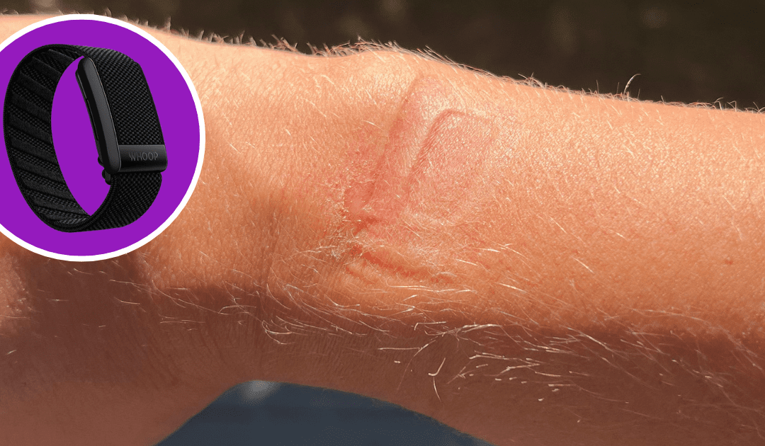 Rash From WHOOP Strap: How to Treat and Prevent It