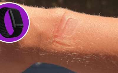 Rash From WHOOP Strap: How to Treat and Prevent It